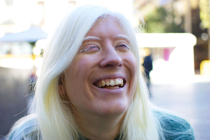 Patty-bonet-albinos